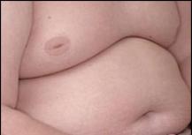 fat-stomach_1_-217x153.jpg